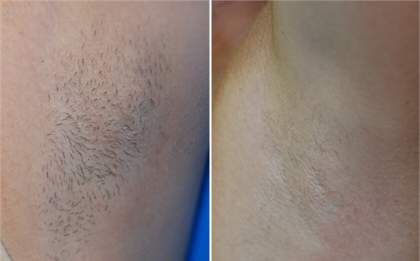 laser-hair-removal-before-after-2