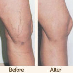 vein-therapy-before-after