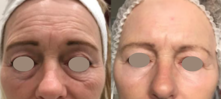 Before and after results of a Tixel thermal energy facial treatment showing dramatic reduction in forehead wrinkles, frown lines, and under-eye skin laxity.