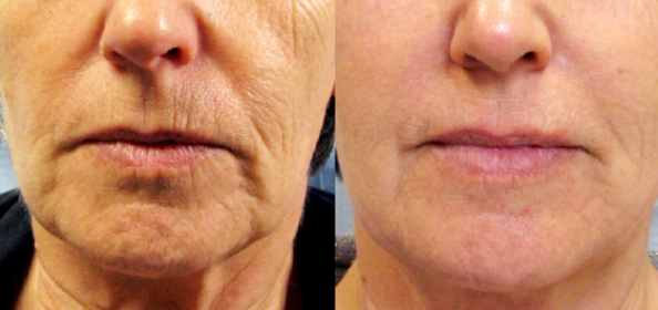Side-by-side before and after comparison of a lower face Tixel skin resurfacing treatment at Laser It! Salon & Medical Spa. The left image shows deep vertical lines around the lips, pronounced smile lines, and skin laxity on the chin. The right image reveals significantly smoother skin texture, reduced wrinkle depth around the mouth, and improved lower face tightness.