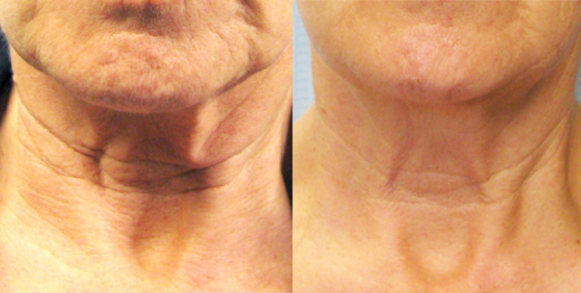 Side-by-side before and after comparison of a Tixel neck tightening and rejuvenation treatment at Laser It! Salon & Medical Spa. The left image shows deep horizontal neck rings, sagging skin laxity, and crepey texture on the neck and jawline. The right image shows dramatically smoother skin, reduced depth of neck bands, and a firmer, tighter jawline.