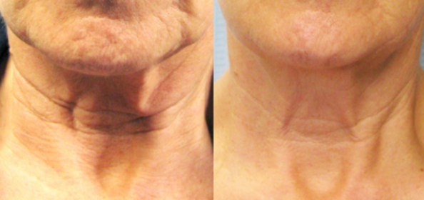 Side-by-side before and after comparison of a Tixel neck tightening and rejuvenation treatment at Laser It! Salon & Medical Spa. The left image shows deep horizontal neck rings, sagging skin laxity, and crepey texture on the neck and jawline. The right image shows dramatically smoother skin, reduced depth of neck bands, and a firmer, tighter jawline.