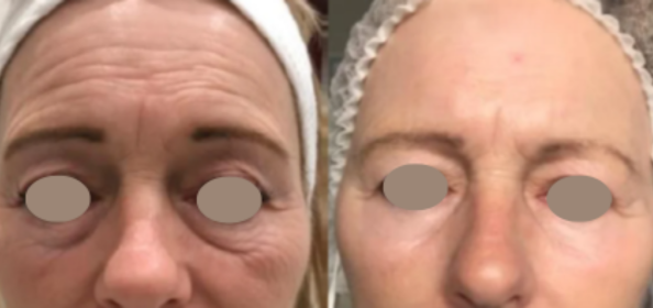 Before and after results of a Tixel thermal energy facial treatment showing dramatic reduction in forehead wrinkles, frown lines, and under-eye skin laxity.
