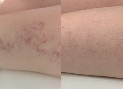 Screenshot 2024-11-15 at 12-15-42 671fdf0ec0a55186404c3c49_ET907334 Sclerotherapy Spider Vein Treatment_Front2.webp (WEBP Image 701 × 451 pixels)