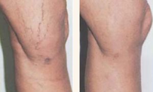 vein-therapy-before-after